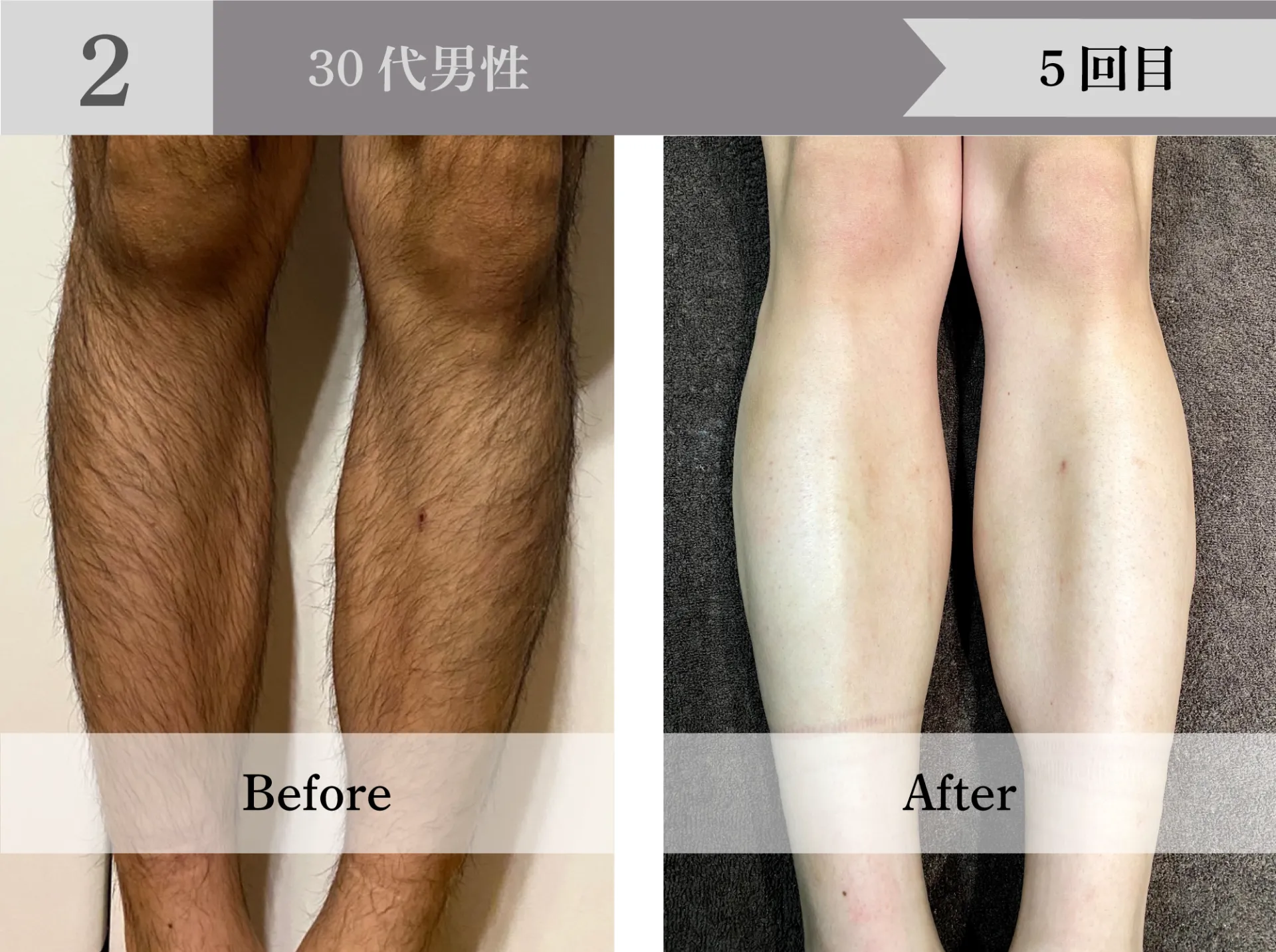30代男性 5回目ビフォーアフター