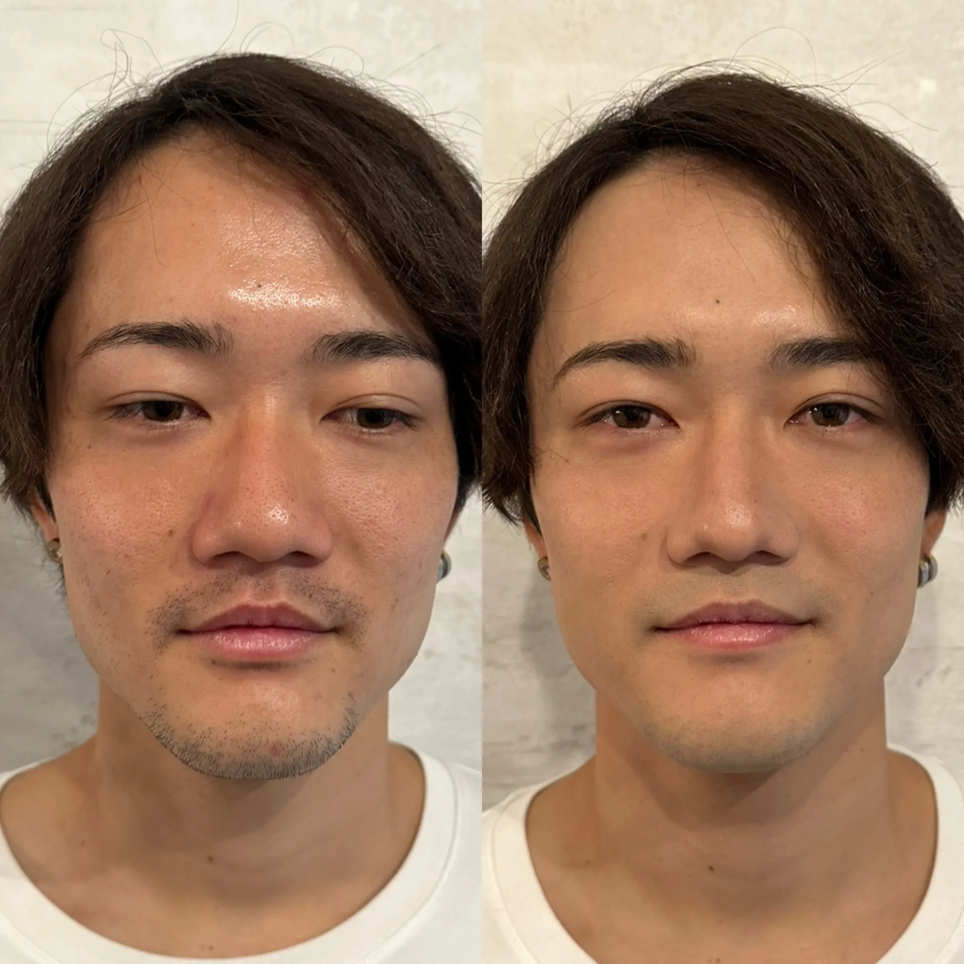 髭全体脱毛&美白フォトフェイシャル ビフォーアフター
