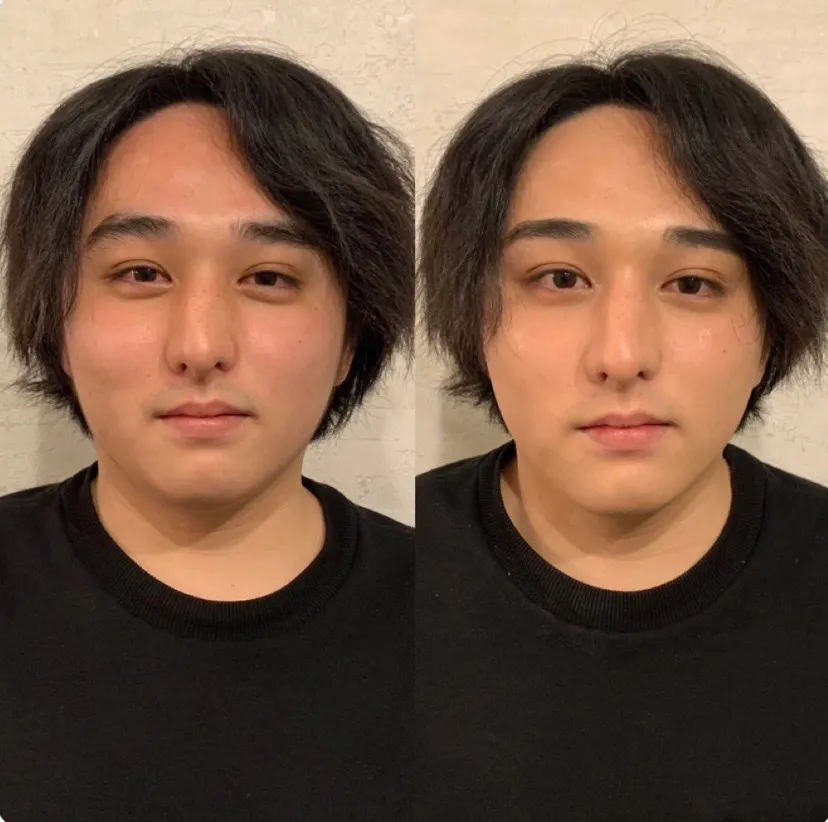 髭脱毛&眉スタイリング脱毛&美白フェイシャル ビフォーアフター