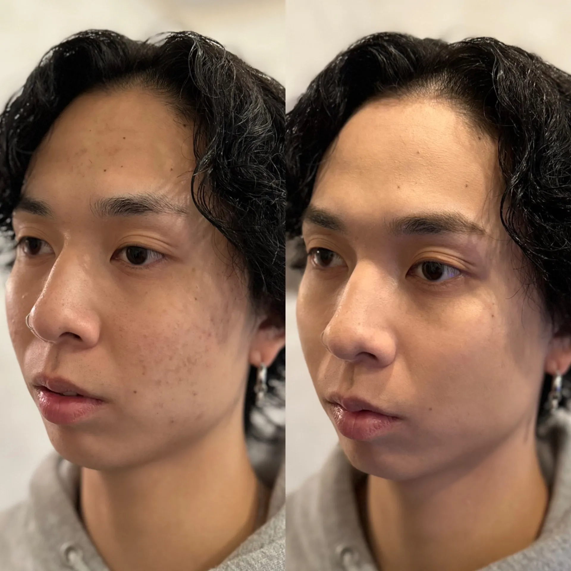 髭脱毛&ニキビ跡フェイシャル&身だしなみメンズメイク ビフォーアフター