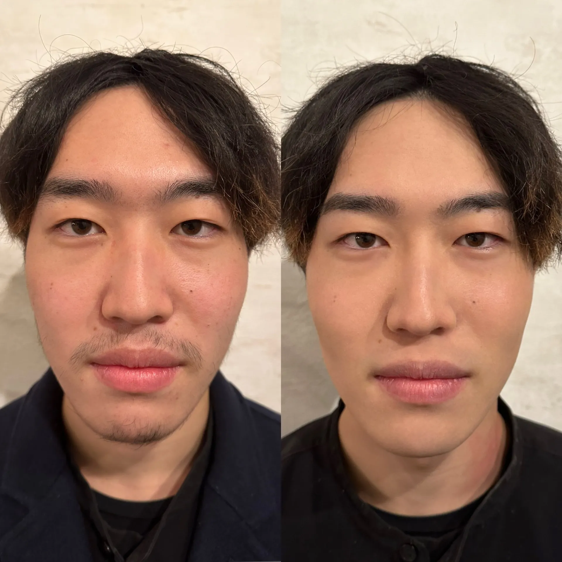 全身脱毛&眉スタイリング脱毛&フェイシャル美白